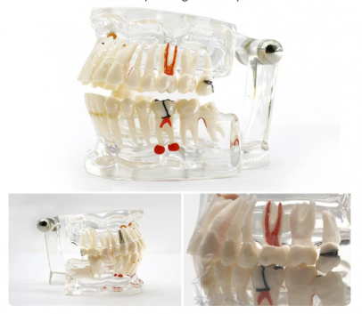 Arcada dentara patologie implant-molar inclus-extruzie HST-C2