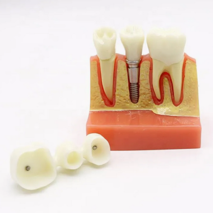 Model educational marit 4X cu implant